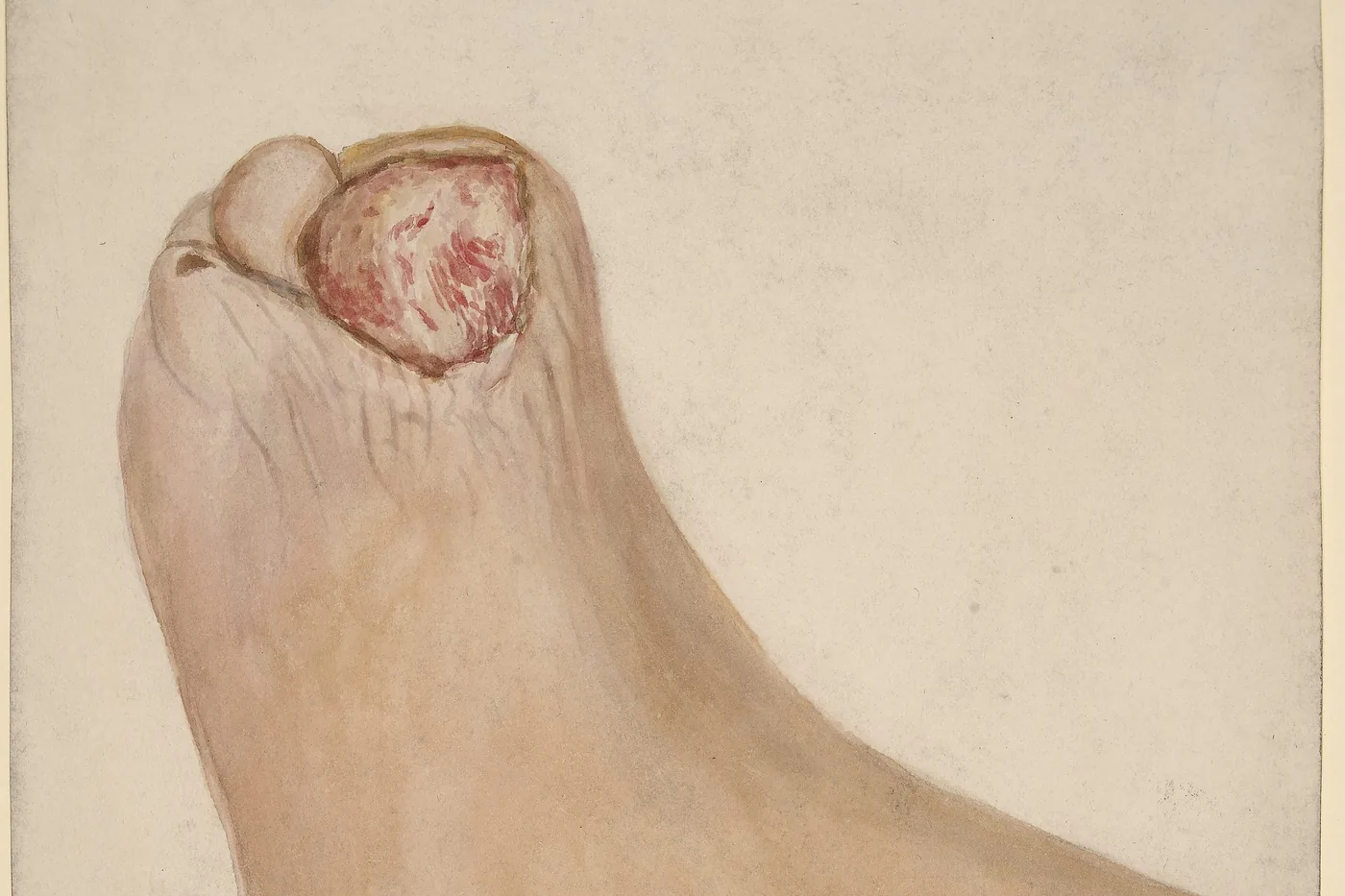 Ilustración médica de pie diabético con úlcera